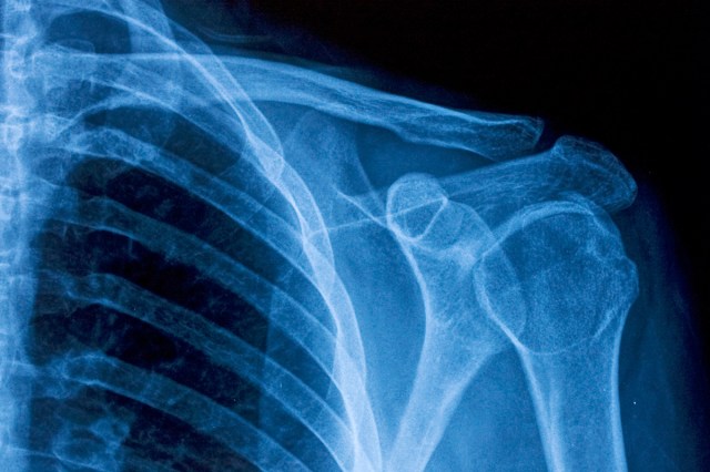 An x-ray of a persons shoulder